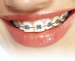 Damon Brackets