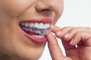 Invisalign®